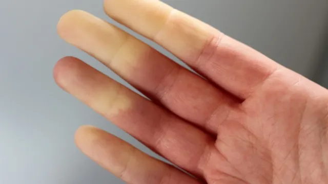 syndroom van Raynaud